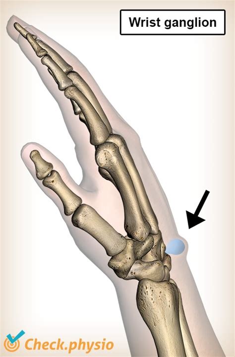 Ganglion Of The Wrist Physio Check