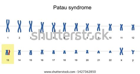 Patau Syndrome Karyotype Autosomal Abnormalities Trisomy Stok Vektör