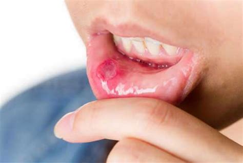 Mouth Ulcers Canker Sores Causes Symptoms Treatment