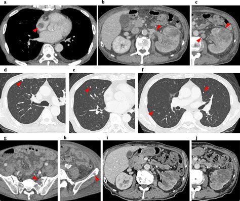 Chest And Abdominal Ct Scan Abnormal Findings Are Indicated By