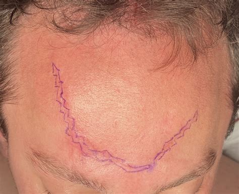 Geometric Forehead Scar Revision Dr Barry Eppley Explore Plastic Surgery