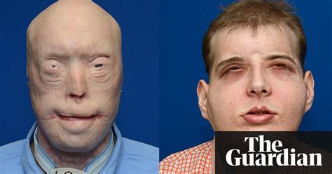 Firefighter Receives Full Face Transplant In Surgery Called Historic