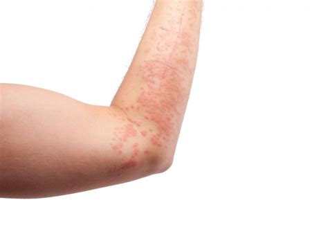 Can Metoprolol Cause Hives