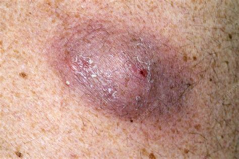 Infected Sebaceous Cyst On Back Stock Image C0213298 Science