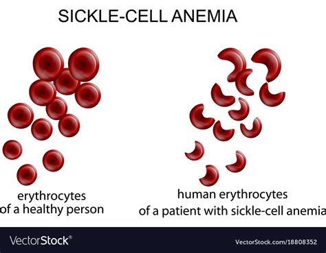 Sickle Cell Anemia Royalty Free Vector Image Vectorstock