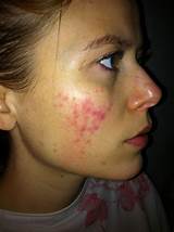Photos of Makeup For Rosacea Skin
