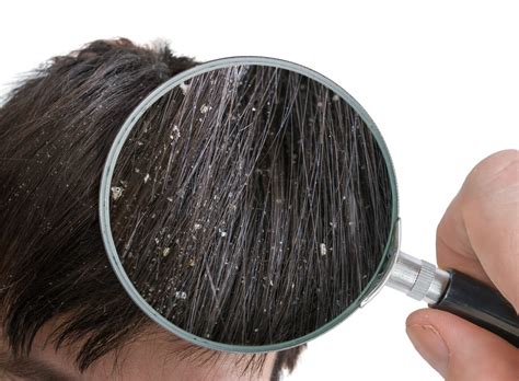 Dandruff Symptoms Causes And Treatment Revere Health