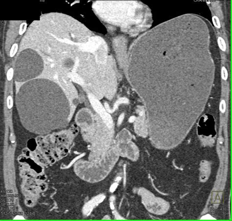 Gastric Gist Tumor And Multiple Liver Cysts Stomach Case Studies