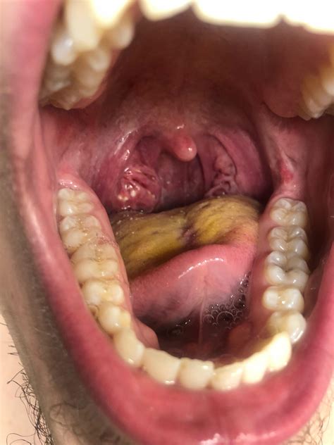 Tonsil Stones Yellow Tongue Canker Sores And Fatigue Any Body Have