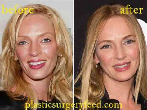 Uma Thurman Plastic Surgery Plastic Surgery Feed