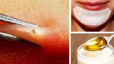 Pin On How To Remove Blackheads
