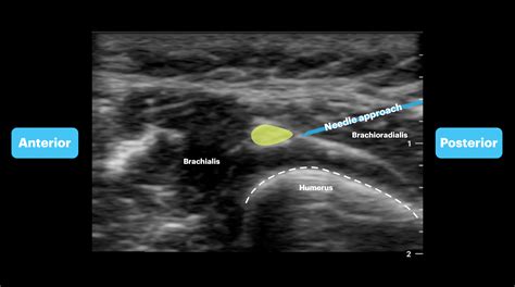 Forearm Nerve Blocks Image Atlas — Tpa