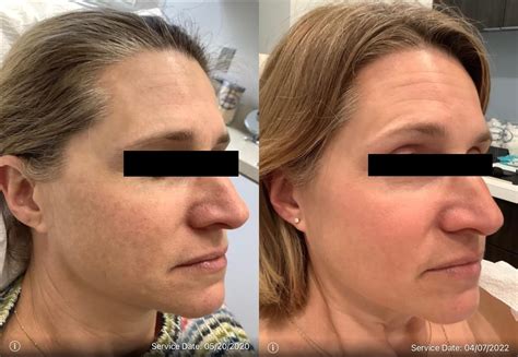 Bbl Before And After Photos Patient 45 Washington Dc Mi Skin Dermatology Center Melda Isaac Md