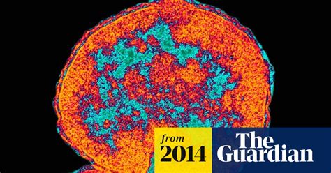 ‘sex Superbug’ Fears Over Powerful New Drug Resistant Strain Of Gonorrhoea Gonorrhoea The