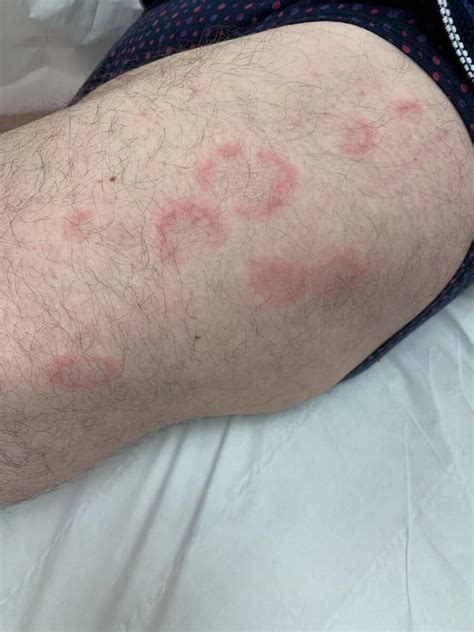 Eosinophilic Annular Erythema