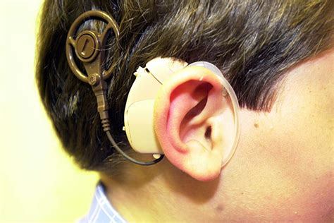 What Is Cochlear Implant Surgery And How Can It Help Deaf People To Hear