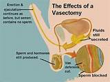 Does Insurance Cover Vasectomy