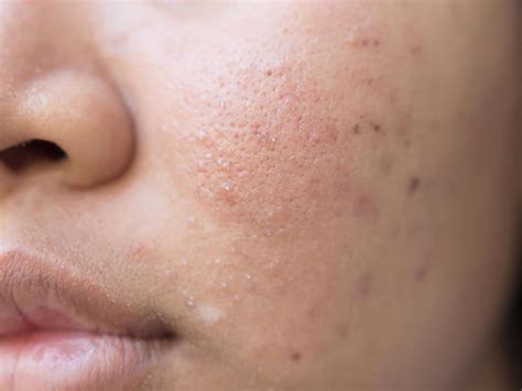 How To Prevent Acne Scars 7 Simple Tips Readers Digest Canada