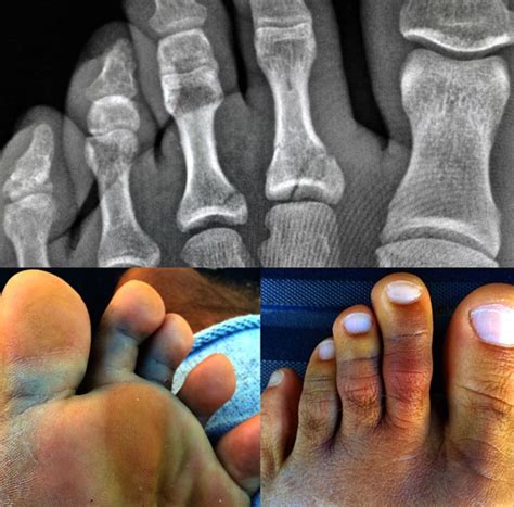 Kelly Slater Confirms Two Broken Toes And Sprain At Cloudbreak The