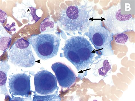 Mesothelioma Vs Reactive Mesothelial Cells Cytology Mesothelioma Cancer