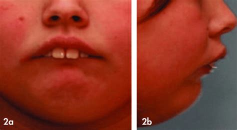A B Pre Treatment Extraoral Photographs Showing A Hyperactive
