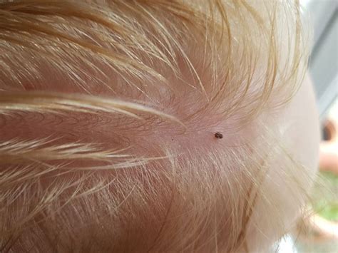 Five Year Old Boy Hospitalised With Suspected Lyme Disease After Being