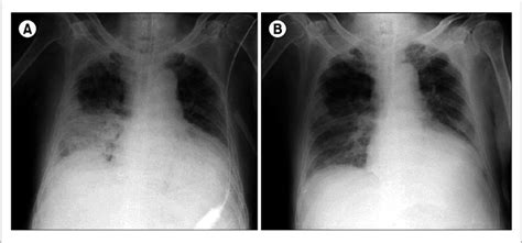 A Chest X Ray Showed Consolidation In Right Lower Lung Field A