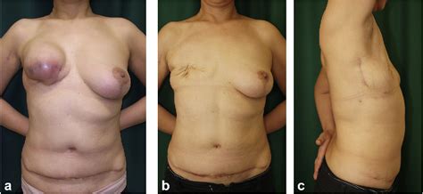 Figure 1 From Tertiary Breast Reconstruction Using A Free Contralateral