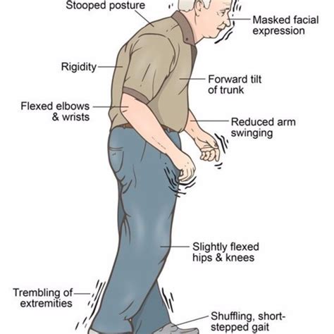 Parkinsons Disease Legacy Spine And Neurological Specialists