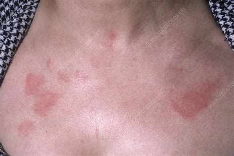 Allergic Contact Dermatitis Stock Image C0494513 Science Photo