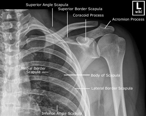 An X Ray Shows The Upper And Lower Parts Of The Shoulder Which Are