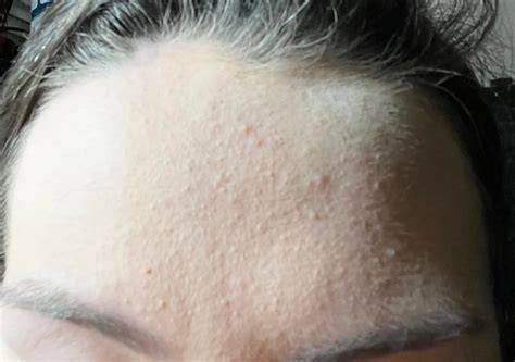 Acne Any Advice To Help With These Awful Bumps Rskincareaddiction