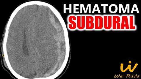 Hematoma Subdural Youtube