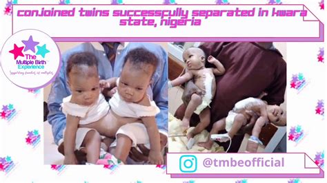 Tmbe News Conjoined Twin Girls Successfully Separated In Nigeria