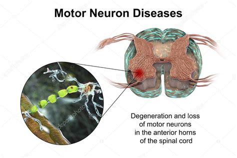 Enfermedades De Las Neuronas Motoras Ilustración 3d Que Muestra