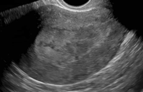 Endometrial Cancer Sagittal Ultrasound Image Of The Uterus Shows A