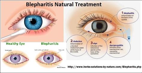 4 Home Base Natural Treatments For Blepharitis