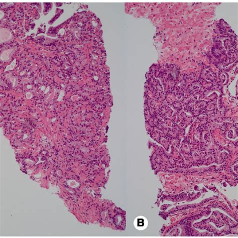 Common Patterns Of Gleason Pattern 4 In Acinar Adenocarcinoma Of The