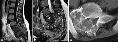 A Case Of Aneurysmal Bone Cyst Showing A Lesion Involving The Sacral