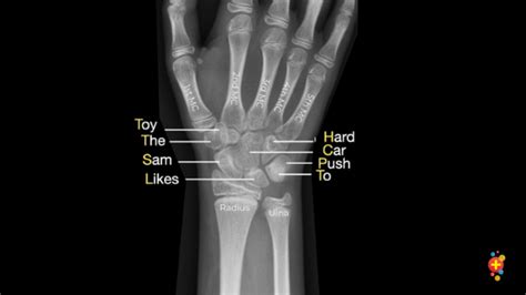 Do X Rays Always Show Broken Bones Whadoq