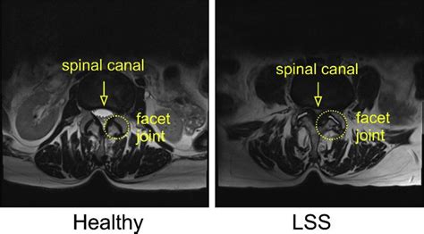 Facet Joint Osteoarthritis In Lumbar Spinal Stenosis Histological