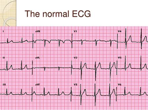 Ppt Ecg Interpretation For Beginners 1 Powerpoint Presentation