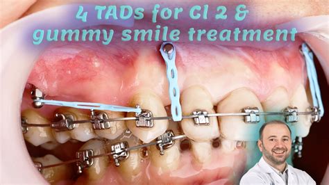 Gummy Smile And Cl 2 Treatment Using Izc And Frontal Tads Mini Screw