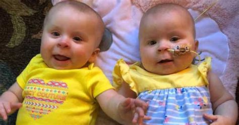 ‘ella Had Tumors In Both Eyes ‘your Twins Have Cancer Things Would Never Be The Same