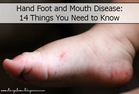 Diseases Adult Hand Foot And Mouth Disease