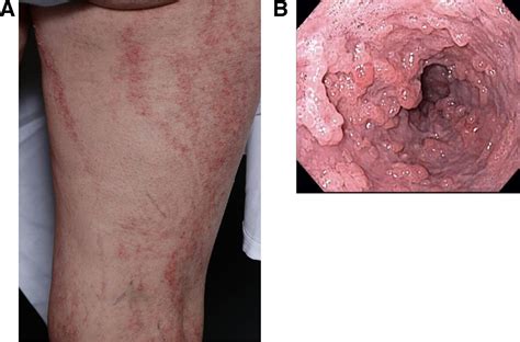 Esophageal Papillomas And Skin Abnormalities Gastroenterology