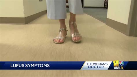 Womans Doctor Diagnosing Lupus