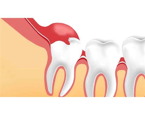 ¿qué Es La Pericoronitis Riesgos Directorio Odontológico