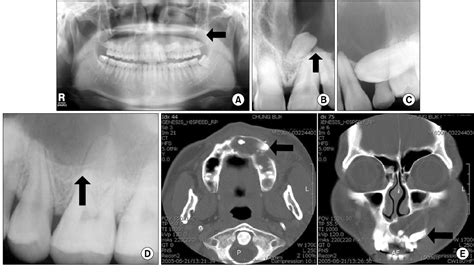 Figure 1 From A Long Term Follow Up Case Of Enucleation Of Dentigerous