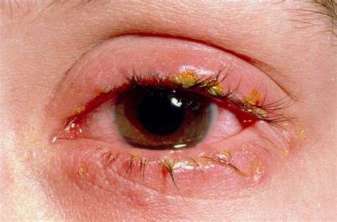 Blepharitisinflammation Of Eyelids Bild Kaufen 11838866 Science